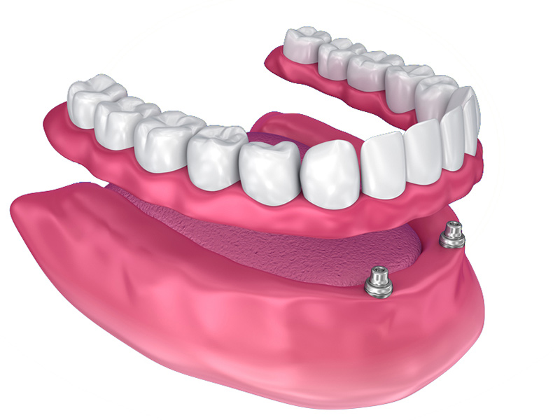 Implant-Retained-Dentures
